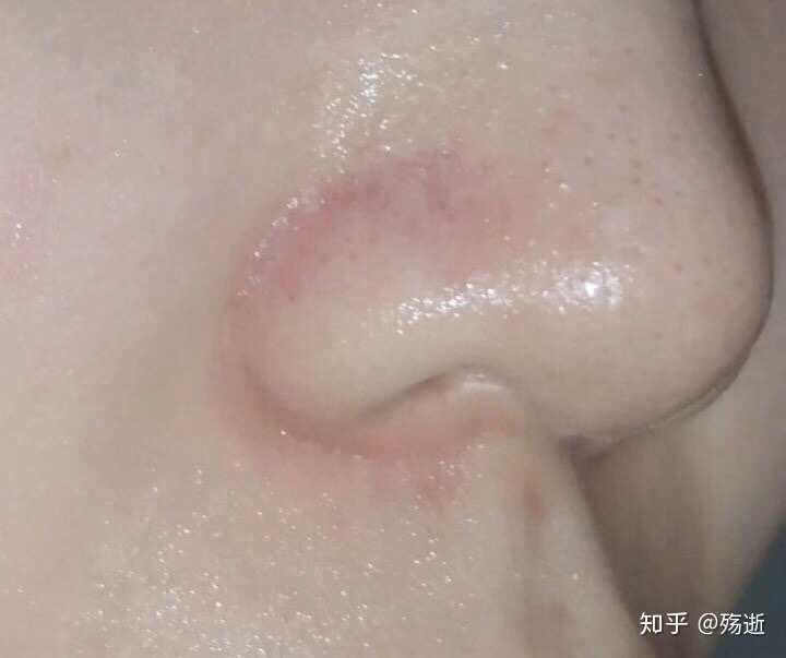 如何去除鼻子上的黑头?