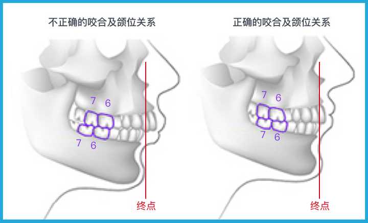 这项技术名为 a6 隐形 sgtb 矫治