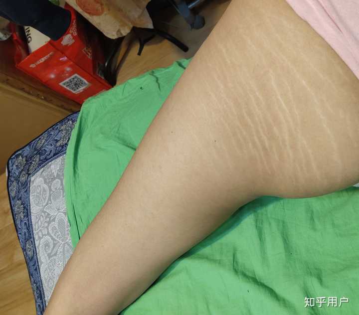 屁股上有生长纹会不会被嫌弃?