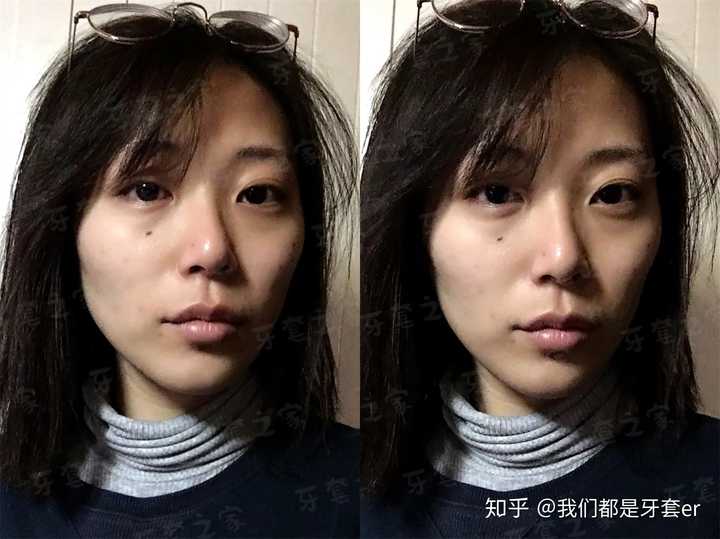 17年3月 牙套脸最严重的时候