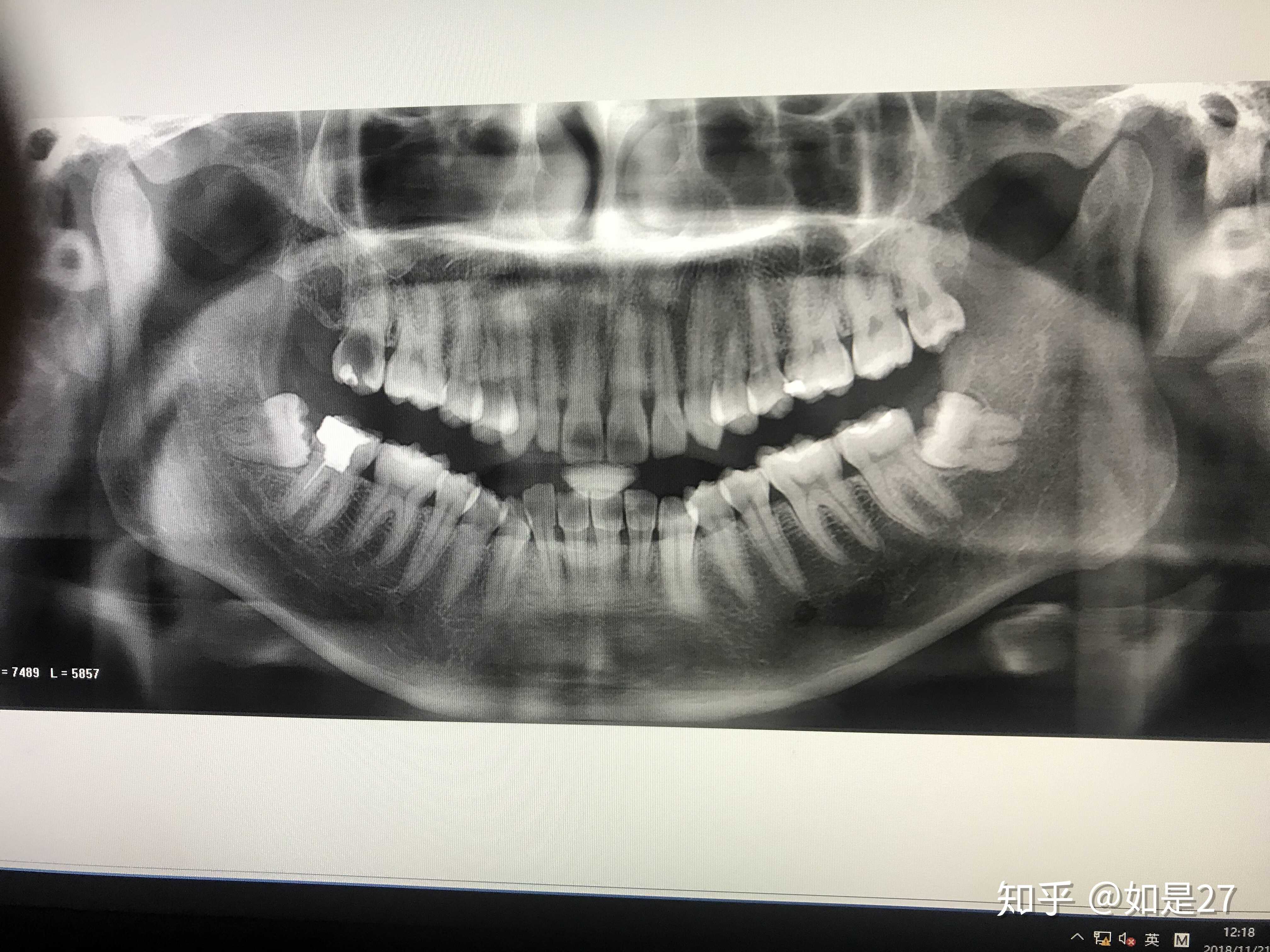 刚拔了上面的牙,下面两颗阻生齿,都需要拔吗,可以一块拔吗