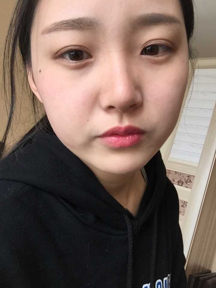 为什么会有天生多眼皮的人?