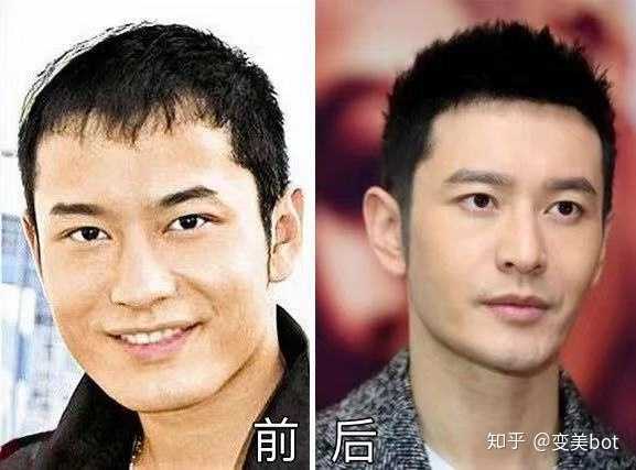 现在植发一般多少钱呢?