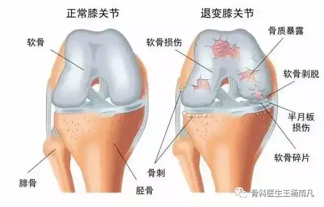 半月板损伤如何治疗调养