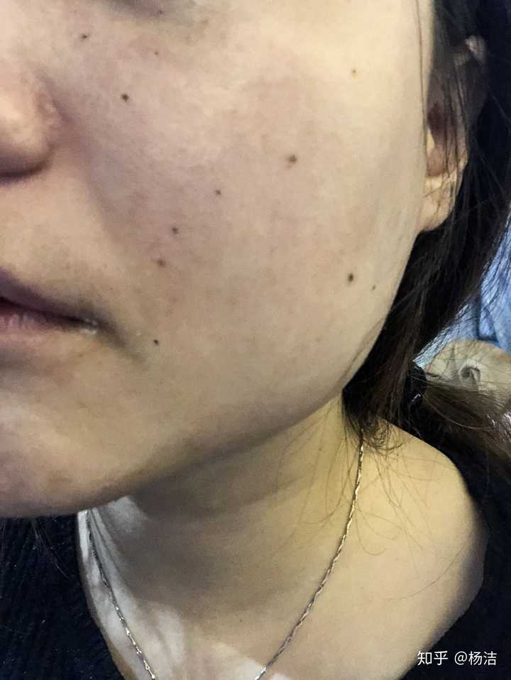 点痣之后如何恢复可以更好?