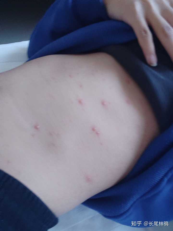 成人长水痘是什么样的经历?