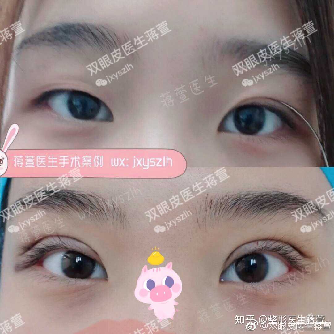 自从我说过重睑术能翘睫以后,很多求美者面诊时都会要求说:"蒋医生我