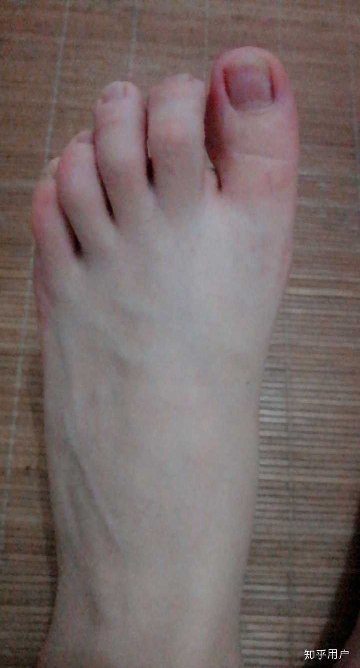 没错,由于鞋子的形状是为正常脚考虑的,所以我的食指经过了这么多年