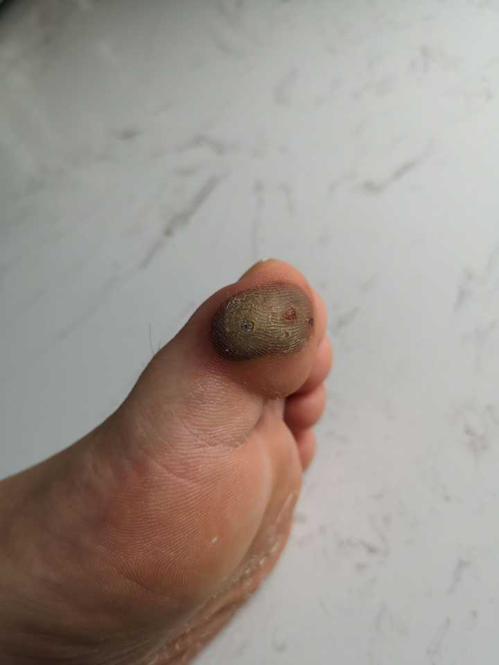 跖疣的自愈性大吗?