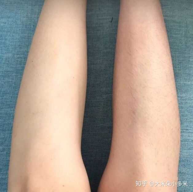 女生如何脱毛?