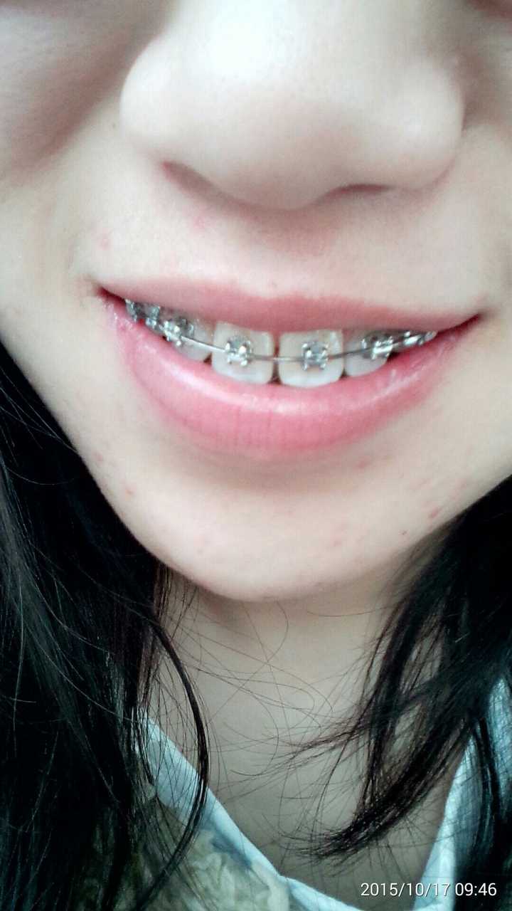 空隙收好后还是觉得上牙微凸 把大门牙处理窄了一丢丢
