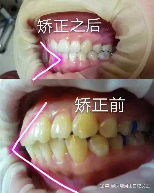 案例图片一般都是牙齿矫正前后对比图,很清晰的可以看到牙齿矫正前后