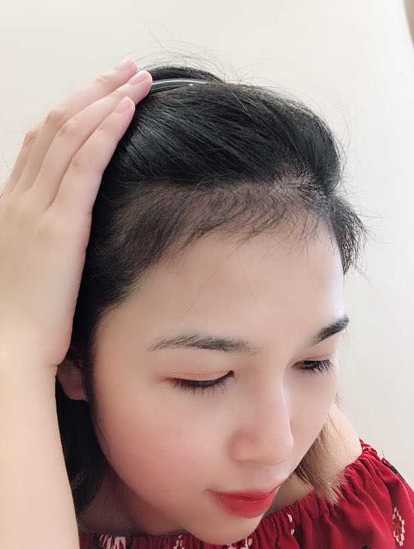 秃头少女适合烫什么发型?