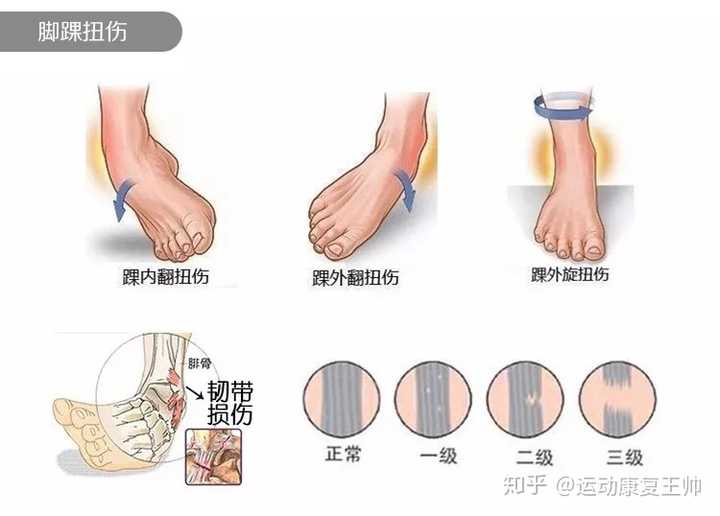 脚踝扭伤,请问一下大家这种情况会不会是纤维束中断?