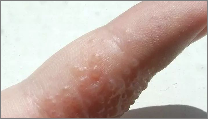 水泡型脚气和汗疱疹的区别