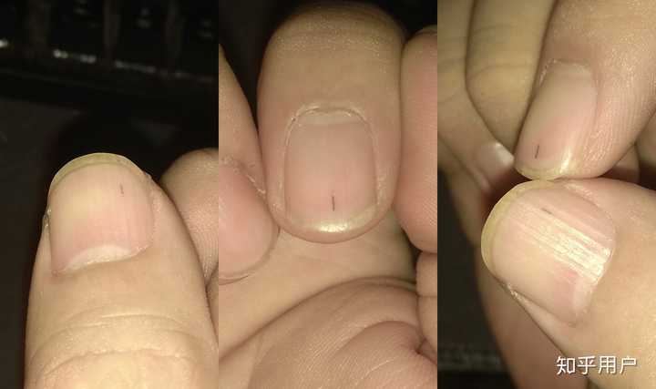 指甲上有细小的黑线是什么回事?