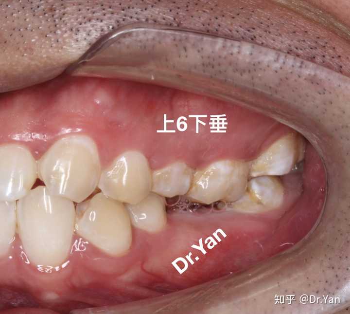 少了一颗牙齿会怎么样?