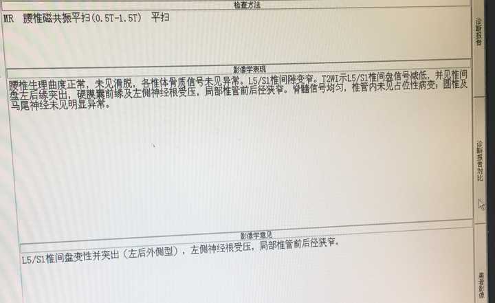 21岁,腰间盘突出,如何治疗与痊愈?