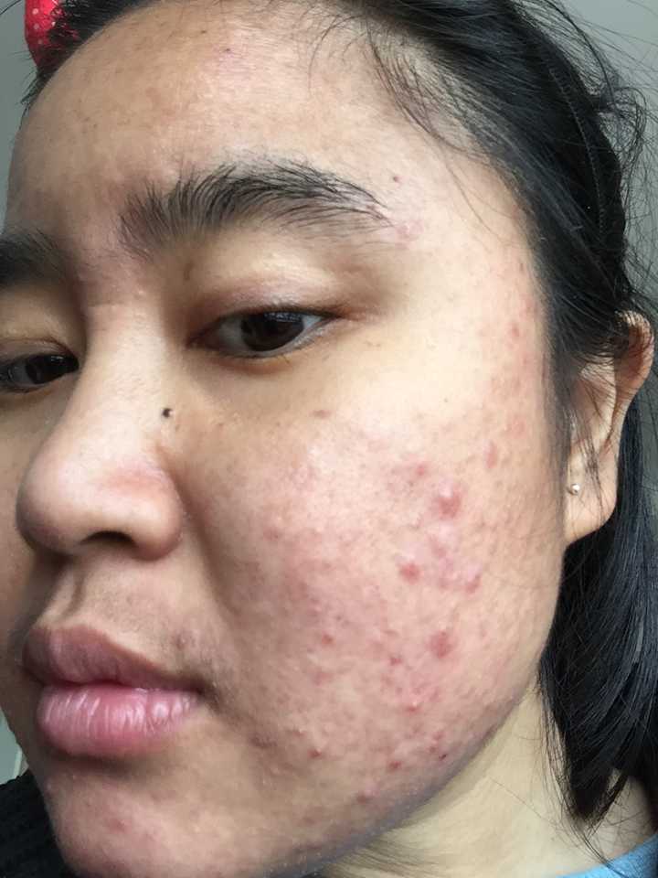 医疗事故汞中毒导致的肾病,吃强的松两年,浑身长毛,满月脸,全是痘
