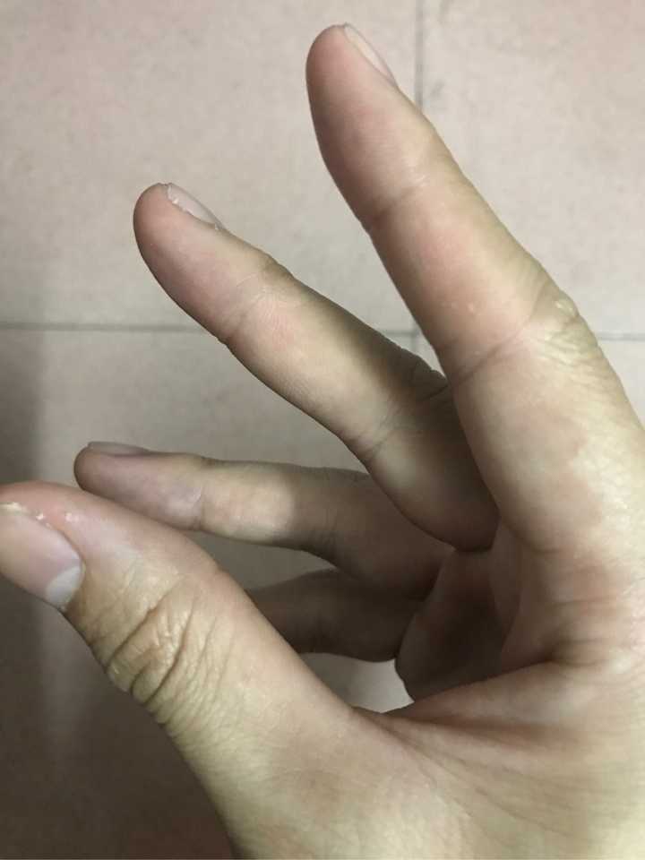 治疗手指上的寻常疣(鱼鳞痣)有什么办法,或者药物?