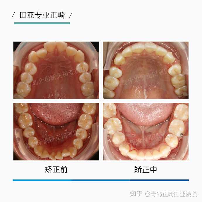 3.「牙齿拥挤,嘴突,牙齿深覆合深覆盖,单颗牙齿反颌」矫正中正畸案例.