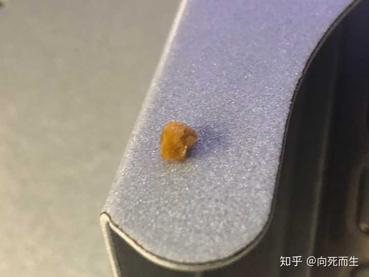 肾结石能完全排出吗?