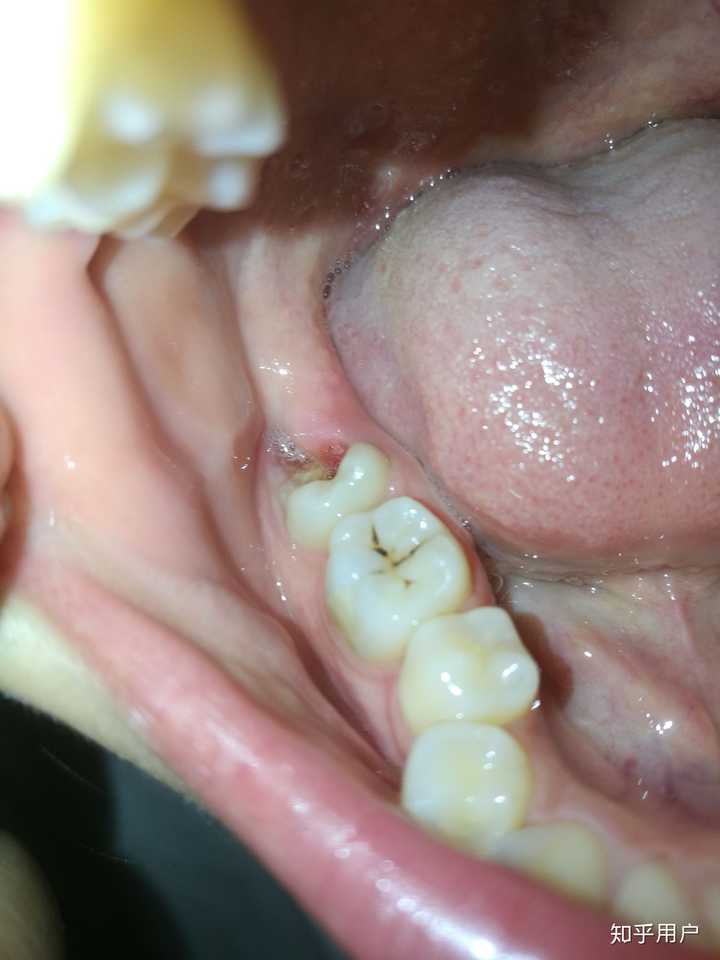 拔智齿时磨坏了旁边的磨牙,暴露了牙本质,医生应该负责吗?