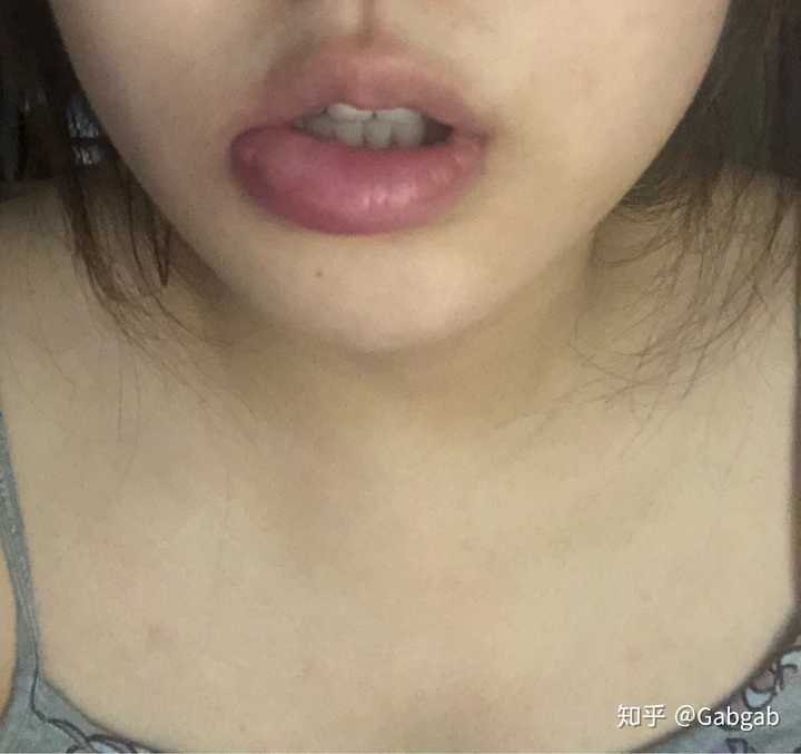 被蚊子咬嘴唇是怎样的一种体验