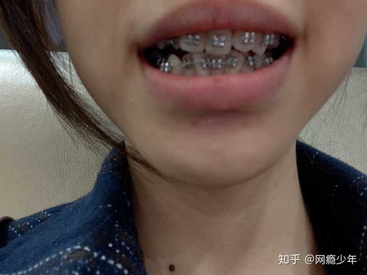 成年人正畸是什么感受