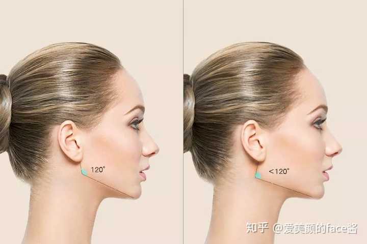 大于100%为重度宽大 「脸方」 对侧脸下颌角角度进行测量,标准如下
