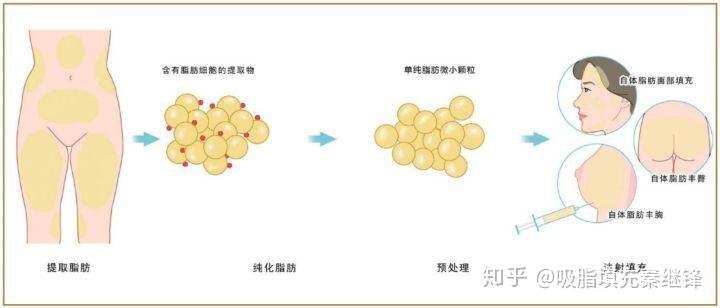 自体脂肪丰胸靠谱吗?