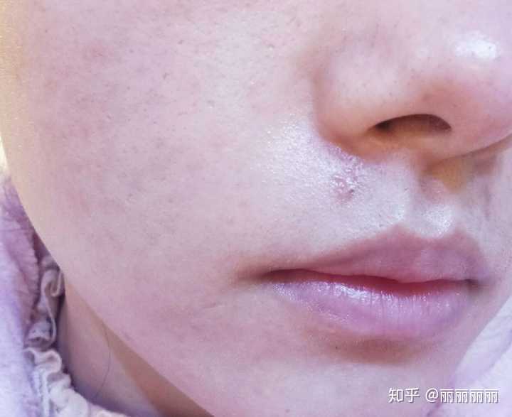 激光点痣和药水点痣那个比较安全