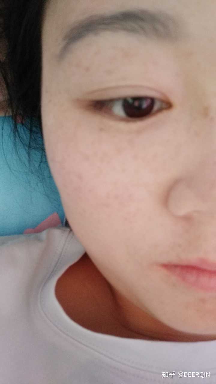 脸上有雀斑是一种什么体验?