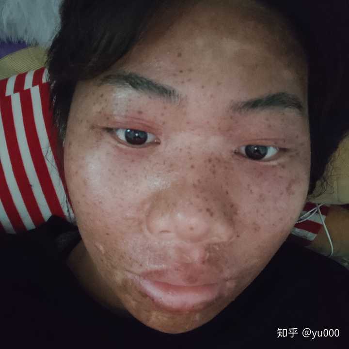 关于美容院的那种药水点痣点斑 有人说有效 有人说点了还不如以前 谁