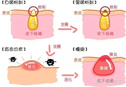 闭口粉刺的形成原因?