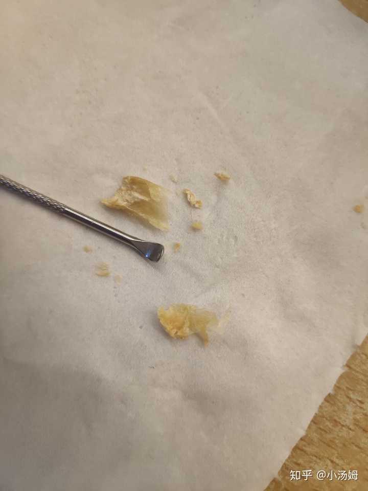 耳屎能大到什么程度?