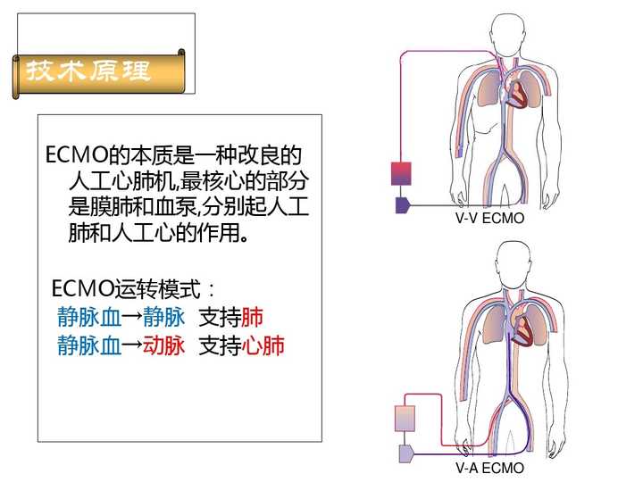 叶克膜(ecmo)是一种什么技术?