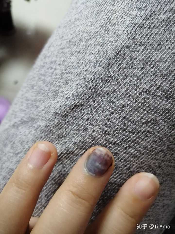 手指头被夹伤后,你是什么样的感受,怎么处理的?