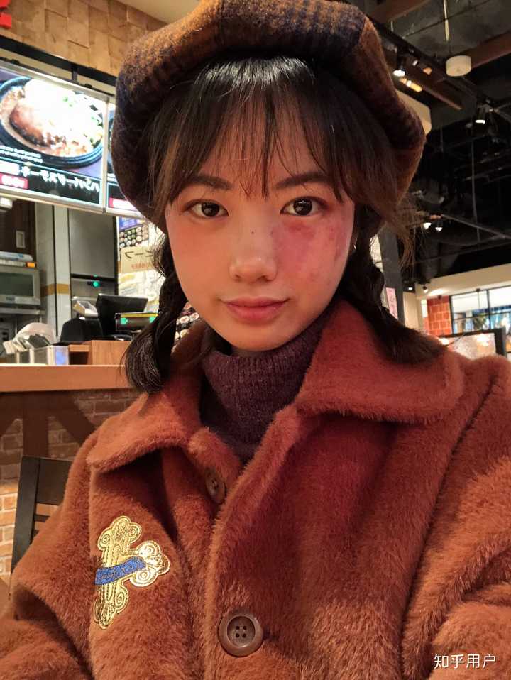 脸上有胎记是一种怎样的体验?
