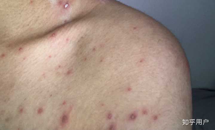 成人长水痘是什么样的经历?