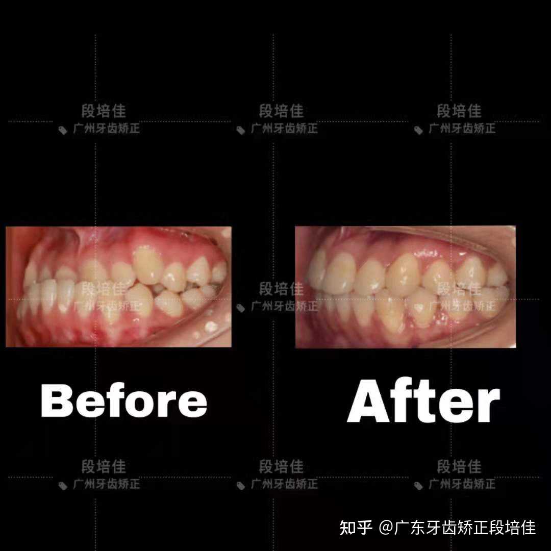 牙槽骨的发育及位置正常在医学上称为牙性畸形此类畸形不需要手术04