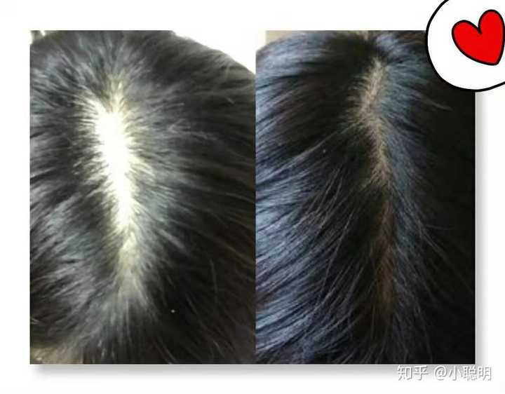 有什么好方法治疗脱发吗?