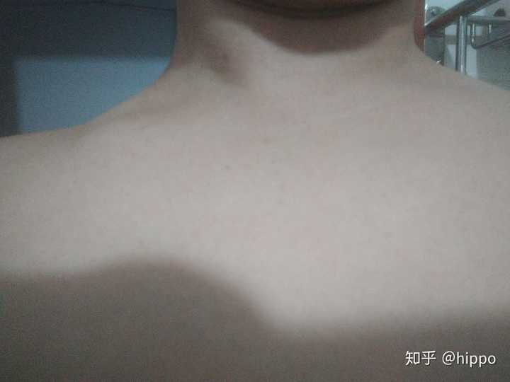 应该是掰腕子等用力过猛,毛细血管破裂造成的吧!