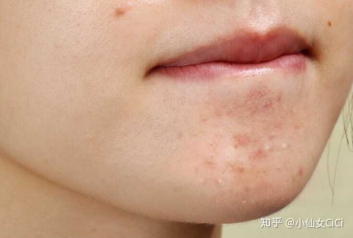 下巴反复长闭口,一大排密密麻麻还凸起怎么办?