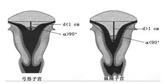 弓形子宫是什么意思