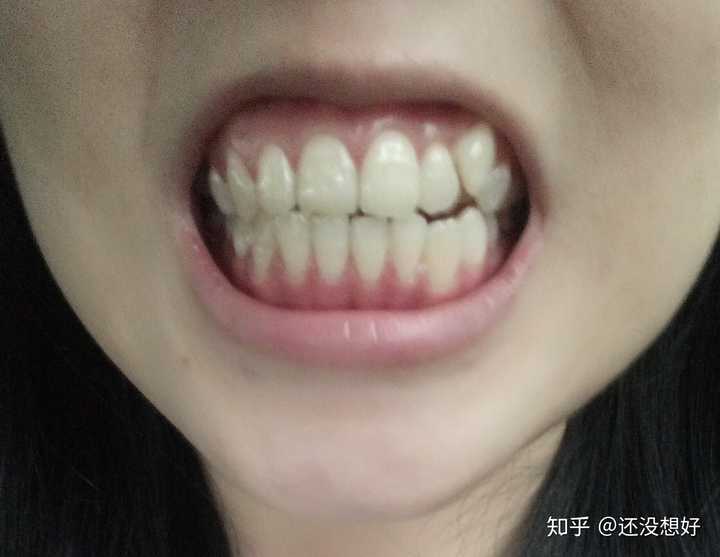 25岁后去矫正牙齿戴牙套是什么体验