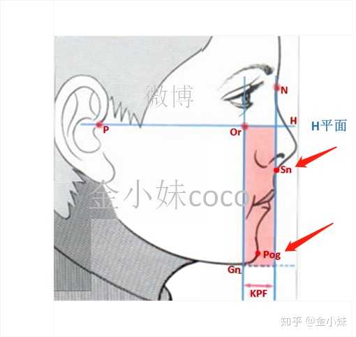 这里,大家注意记住这个 鼻底点sn'和 颏前点pog'