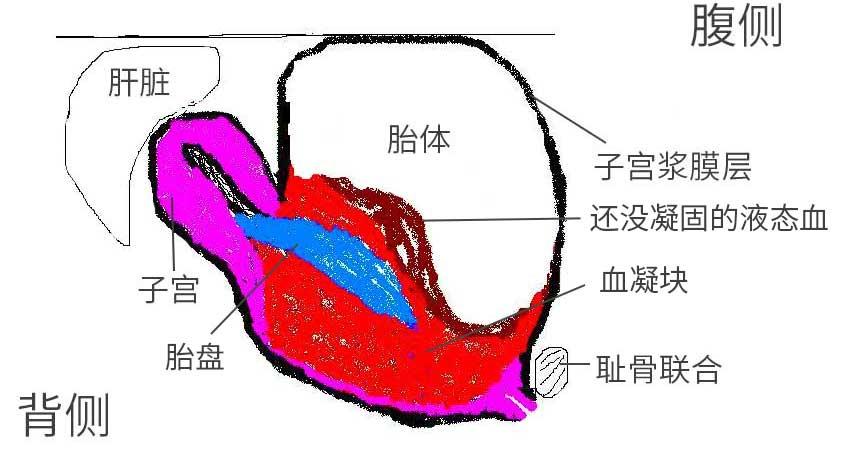 破出子宫的胎体示意图(矢状面)