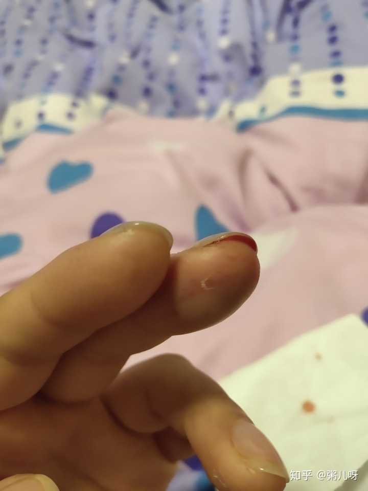 手指头被夹伤后,你是什么样的感受,怎么处理的?