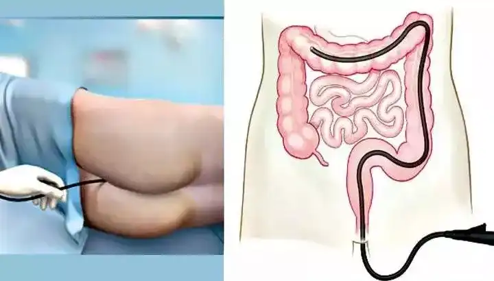 肠癌的早期症状都有什么?